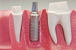 Tand implant